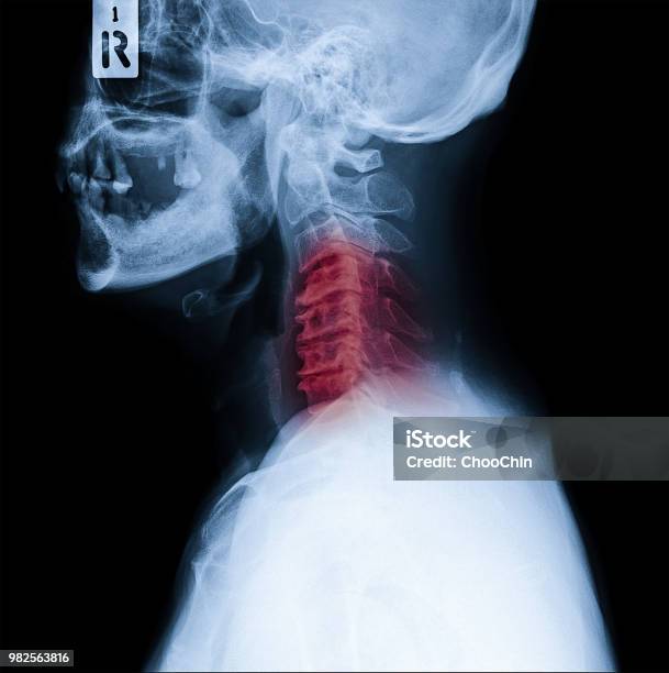 Xray Of Neck And Cervical Spine Side View Image Of Radiography From Patient Who Have Neck Pain Nerve Root Compression Numbness At Arm Hand Wrist Or Finger Stock Photo - Download Image Now