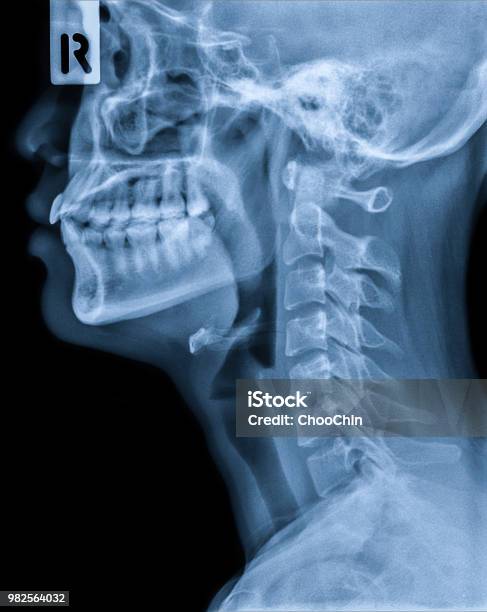 Xray Of Neck And Cervical Spine Side View Image Of Radiography From Patient Who Have Neck Pain Nerve Root Compression Numbness At Arm Hand Wrist Or Finger Stock Photo - Download Image Now