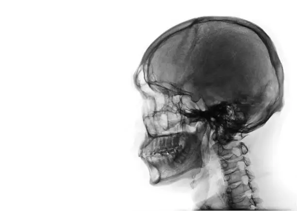 Photo of X-ray image of side view asian skull black and white