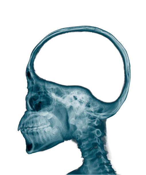 x-ray-image-of-skull-with-blank-area-at-brain-empty-space-in-head-conceptual-image-of-a-open.jpg?s=612x612&w=0&k=20&c=qoYofseMXZO9Nzgw35mNQjQRhq7t1z81FRaoEga_cmc=