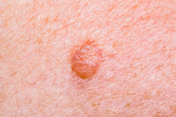 istock Skin Mole Defect High Magnification Macro Photo for Medical Diagnosis 982998844