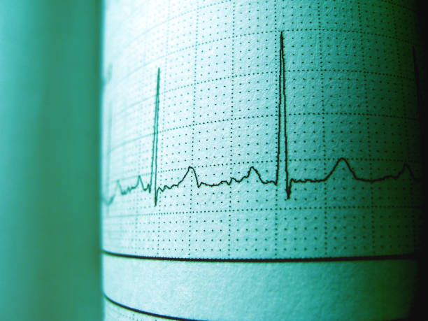 istock Sinus Heart Rhythm On Electrocardiogram Record Paper Showing Normal P Wave 983095806