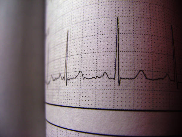 istock Sinus Heart Rhythm On Electrocardiogram Record Paper Showing Normal P Wave 983095818