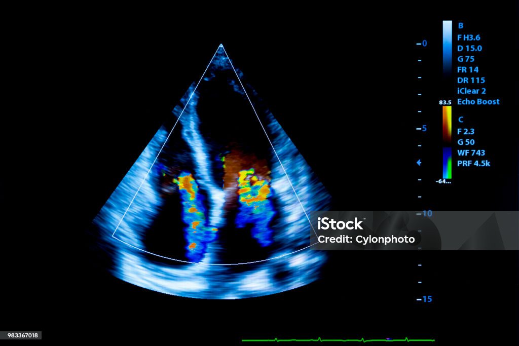 Buntes Bild der Homan Herz-Ultraschall-monitor - Lizenzfrei Echokardiogramm Stock-Foto