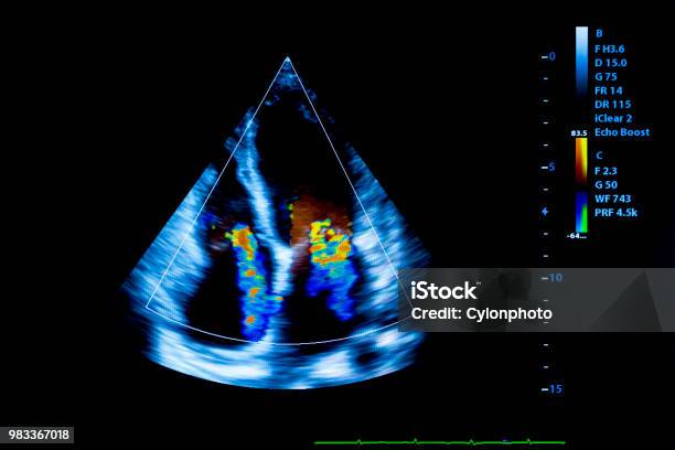 Buntes Bild Der Homan Herzultraschallmonitor Stockfoto und mehr Bilder von Echokardiogramm - Echokardiogramm, Medizinischer Test, Ultraschall-Untersuchung