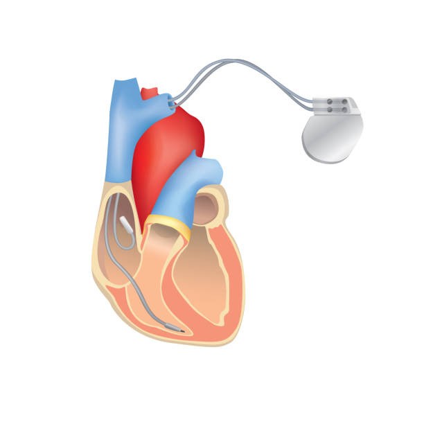 stockillustraties, clipart, cartoons en iconen met de pacemaker van het hart in werk. anatomie van het menselijk hart dwarsdoorsnede met werken van implanteerbare cardioverter defibrillator. - defibrillator