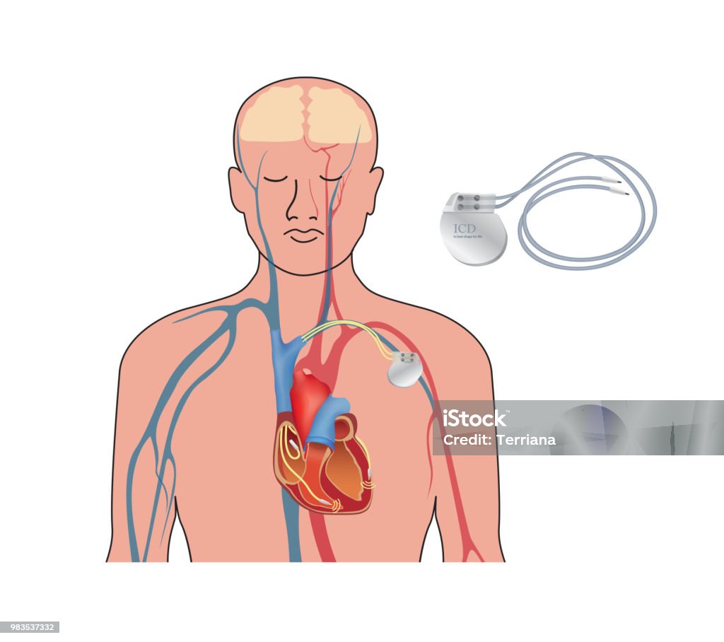 심장 박 동기 작업입니다 인간의 심장 인공 심장 Icd 심박 조율기에 대한 스톡 벡터 아트 및 기타 이미지 - 심박 조율기 ...