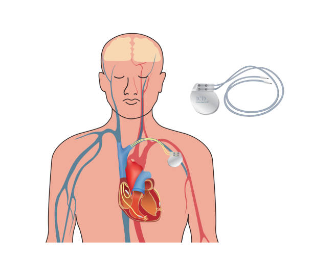 stockillustraties, clipart, cartoons en iconen met de pacemaker van het hart in werk. menselijk hart kunstmatige cardiale, icd - defibrillator