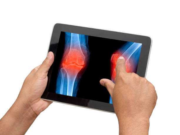 의사가 의료 응용 프로그램에 염증과 관절염 무릎의 x 선 이미지를 확인 하려면 태블릿을 사용 하 여. - digital tablet doctor note pad x ray image 뉴스 사진 이미지