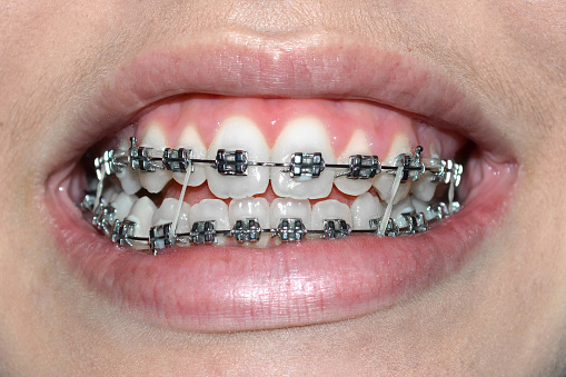Bretelle Dentali Con Elastici Ortodontici - Fotografie stock e