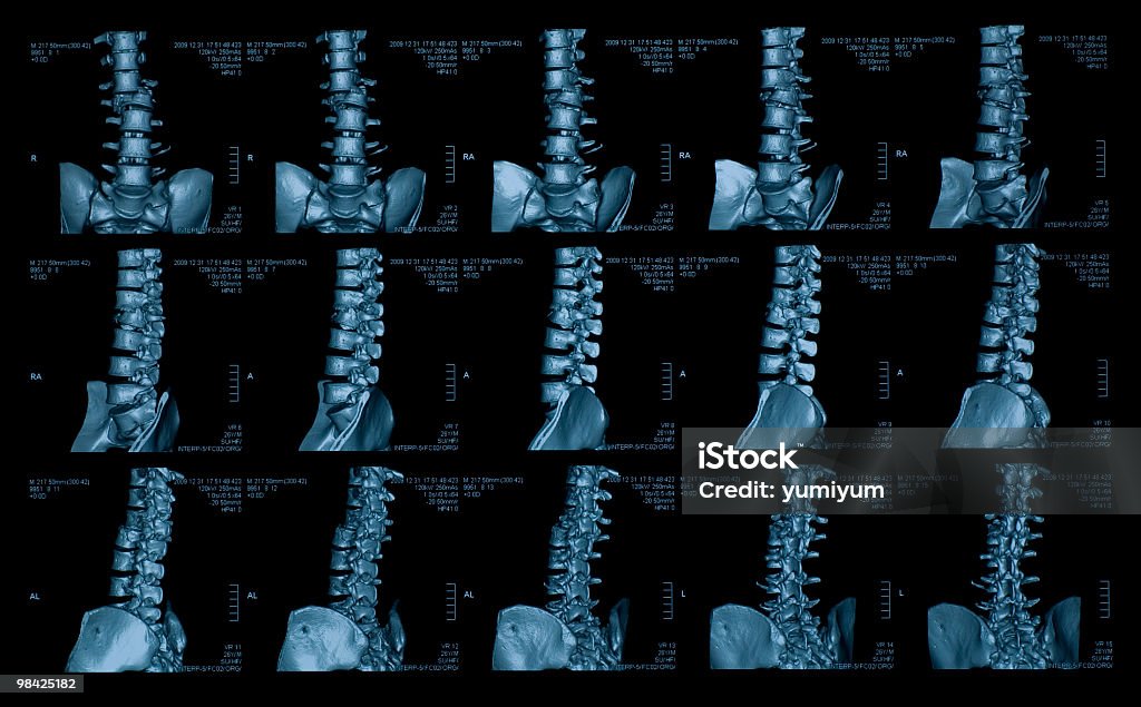 척추뼈 - 로열티 프리 X-레이 스톡 사진