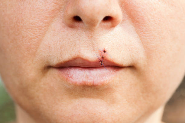 istock woman with stitches on her lip. 984440432