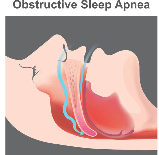 ilustraciones, imágenes clip art, dibujos animados e iconos de stock de ronquido es la vibración de las estructuras respiratorias y el sonido resultante debido al movimiento de aire obstruido durante la respiración mientras duerme. - apnea del sueño