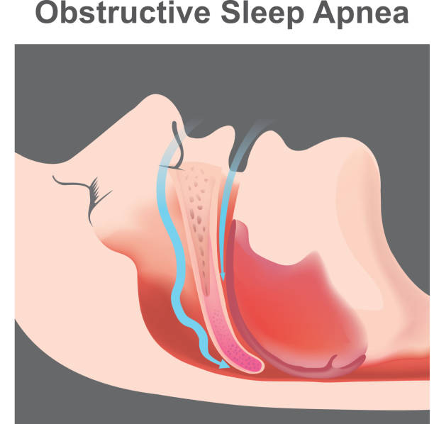 Snoring is the vibration of respiratory structures and the resulting sound due to obstructed air movement during breathing while sleeping. vector art illustration