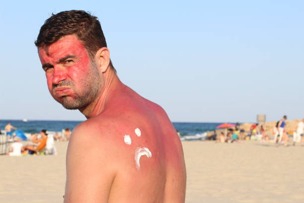 uomo scottato dal sole in spiaggia - shirtless male men people foto e immagini stock