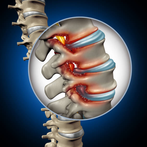 Spinal Stenosis Medical Concept Spinal Stenosis medical concept as a degenerative illness in the human vertebrae causing compressed spine nerves human body disease as a 3D illustration. herniated disc stock pictures, royalty-free photos & images