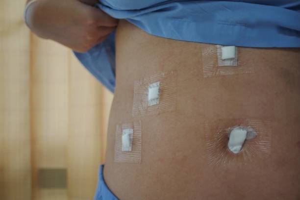 An abdomen of adult Asian female patient with Waterproof Transparent Dressing after Cholecystectomy or Laparoscopic Gallbladder Surgery. An abdomen of adult Asian female patient with Waterproof Transparent Dressing after Cholecystectomy or Laparoscopic Gallbladder Surgery for gallstones removal. gall bladder stock pictures, royalty-free photos & images
