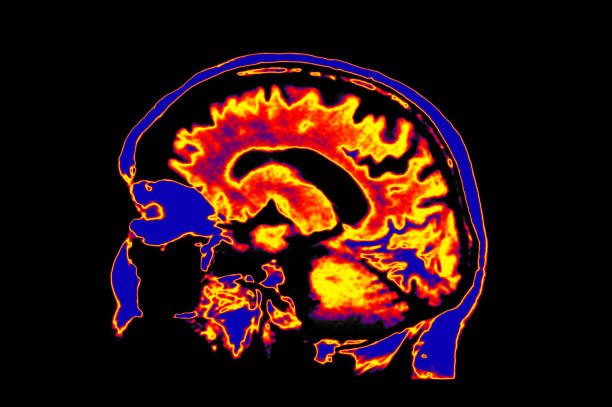 istock Colorized MRI Image Of Head Showing Brain 986666126