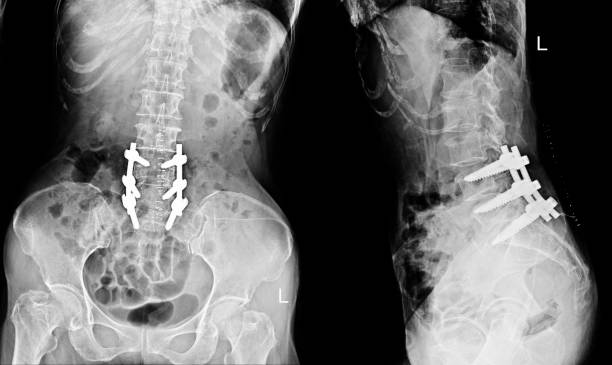 istock X-ray Lumbar spine show post operation Laminectomy with plate screw 986783876