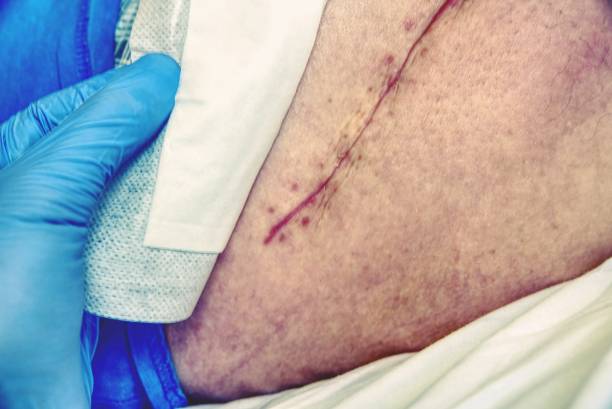 신선한 긴 흉터는 엉덩이 수술 후 환자. 매크로, 인간의 다리 - pacemaker torso chest male 뉴스 사진 이미지