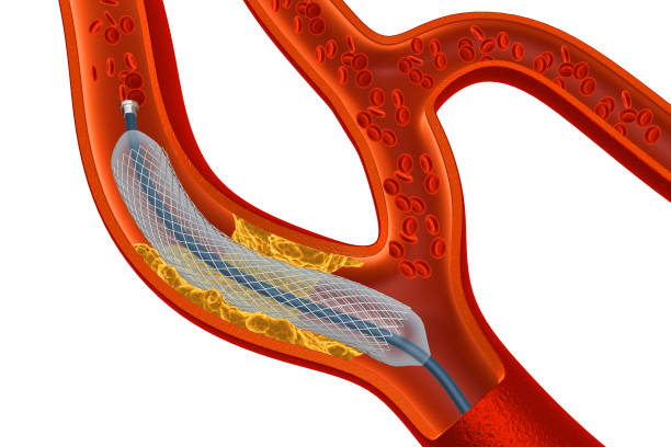 istock Balloon Expandable Stent. Anatomical concept 987392754