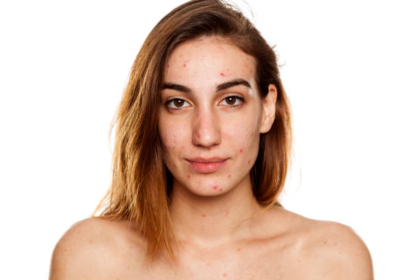 istock young woman with problematic skin and without makeup poses on a white background 987442172