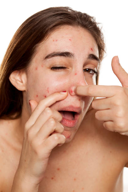 istock young unhappy woman with problematic skin and without makeup squeeze her acne on a white background 987442192