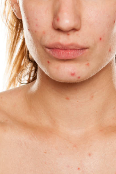 istock young woman with problematic skin and without makeup poses on a white background 987442198