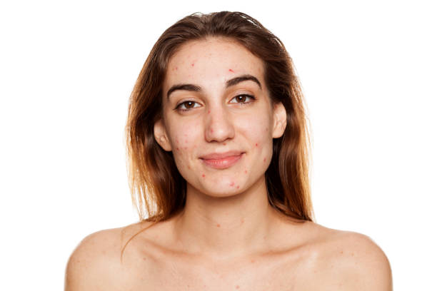 istock young smiling woman with problematic skin and without makeup poses on a white background 987442230