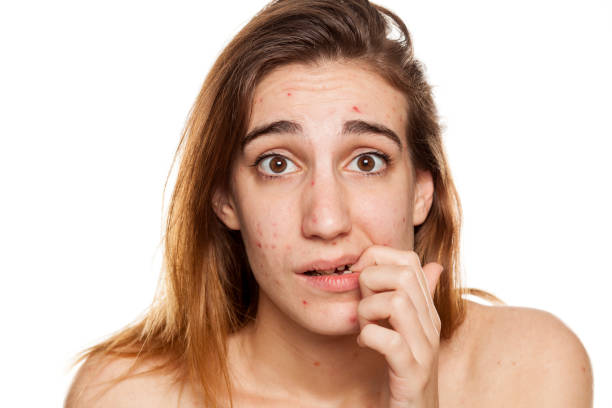 istock young worried woman with problematic skin and without makeup poses on a white background 987442264