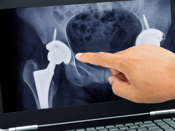 doctor's hand pointing xray photos of total hip replacement in medical application on black laptop computer doctor's hand pointing xray photos of total hip replacement in medical application on black laptop computer hip joint x stock pictures, royalty-free photos & images