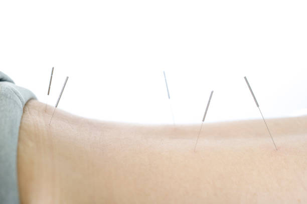 istock Acupuncture treatment in Asia 988138172