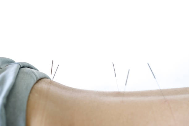 istock Acupuncture treatment in Asia 988138344
