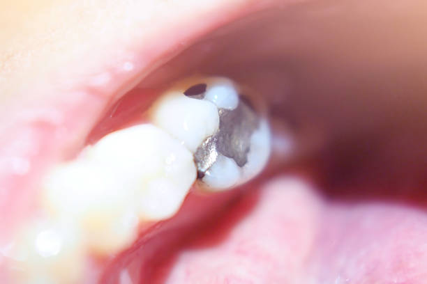 close up macro photo of Metall amalgam dental fillings stock photo