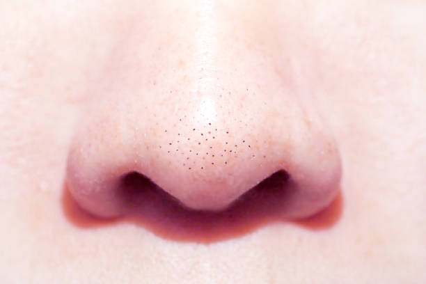 close up macro of many acne small blackhead pimples on the nose stock photo