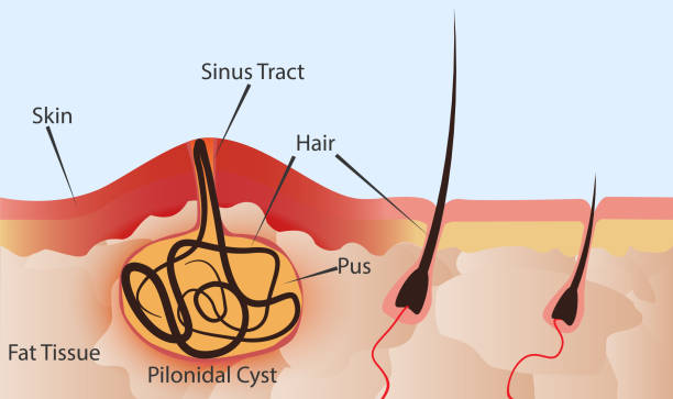 Pilonidal Cyst Formation Stock Illustration - Download Image Now - Cyst,  Illness, Hair - iStock