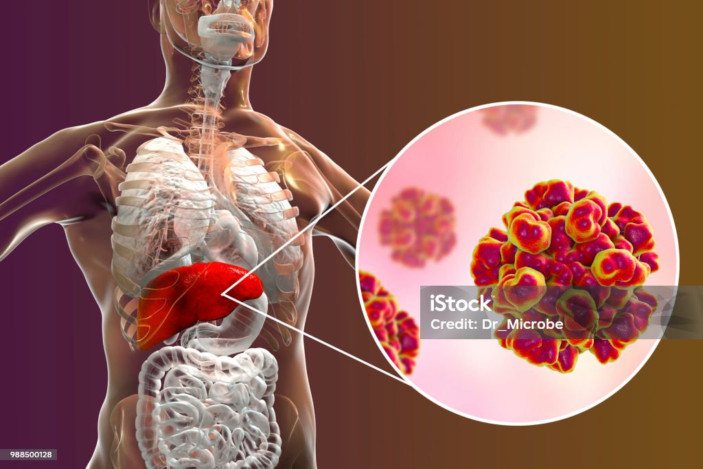 Hepatitis E viral infection Hepatitis E viral infection, 3D illustration. Non-enveloped RNA viruses with fecal-oral transmission route, the causative agent of hepatitis Hepatitis Stock Photo