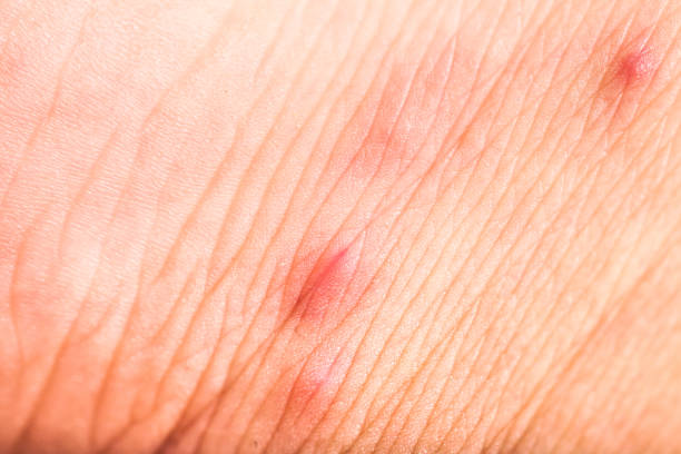 istock red rash bite by cat flea in human skin 989069588