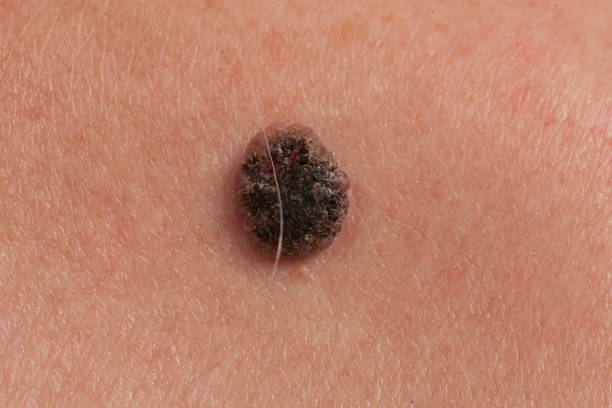 istock Skin cancer in men. 989988972