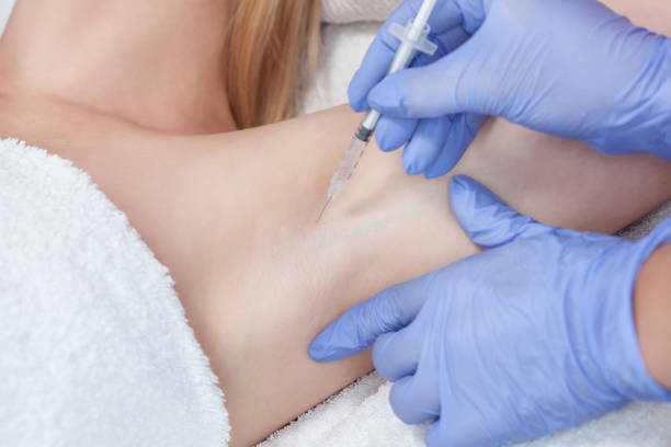 The doctor makes intramuscular injections of botulinum toxin in the underarm area The doctor makes intramuscular injections of botulinum toxin in the underarm area against hyperhidrosis. sweat gland stock pictures, royalty-free photos & images