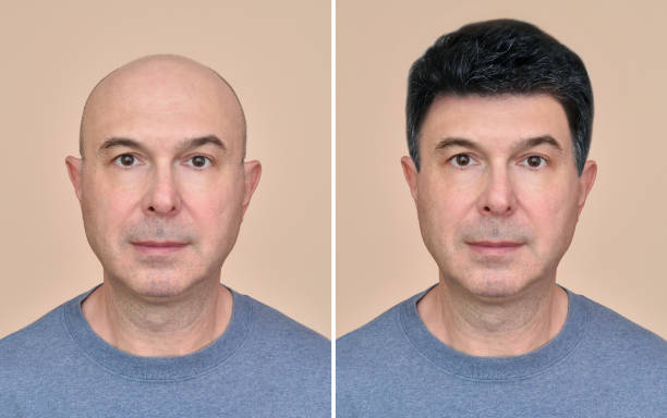 istock Man with and without hair 991878160