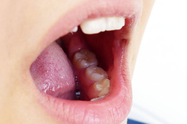 istock neglected mouth, teeth yellowed, tonsillitis, 992047304