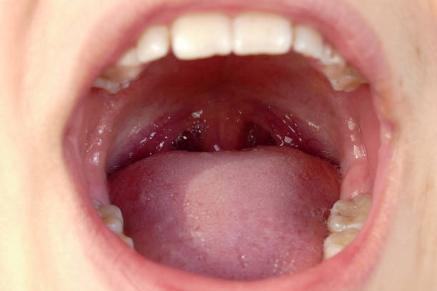 bambini con salute orale e tonsillite, - ugola foto e immagini stock