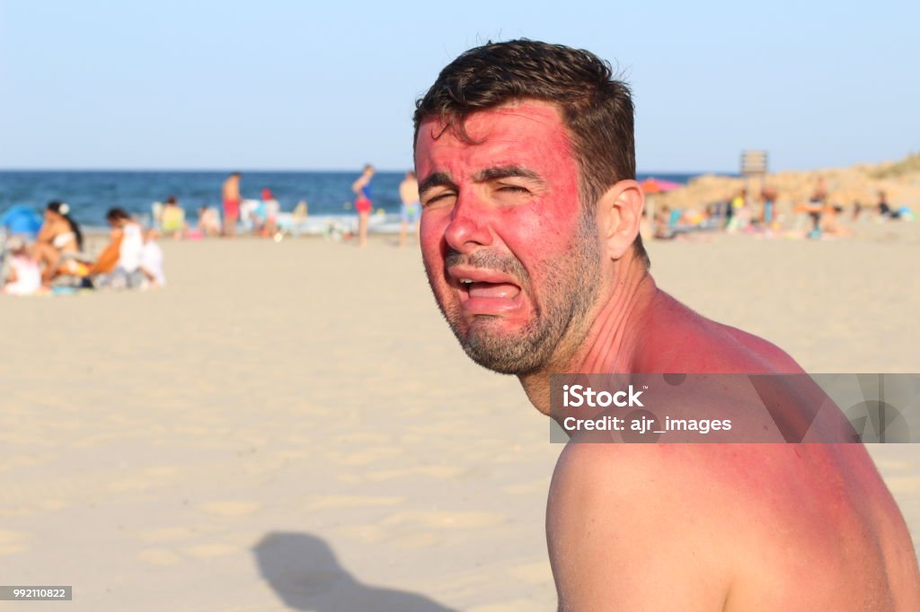 Hombre llorando después violentamente conseguir quemada por el sol - Foto de stock de Quemado por el sol libre de derechos
