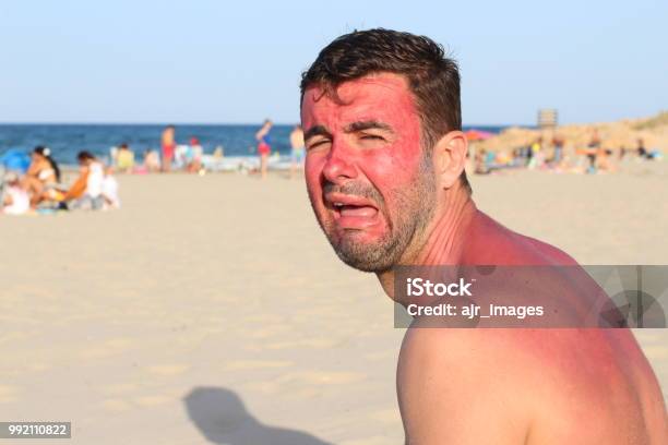 Hombre Llorando Después Violentamente Conseguir Quemada Por El Sol Foto de stock y más banco de imágenes de Quemado por el sol