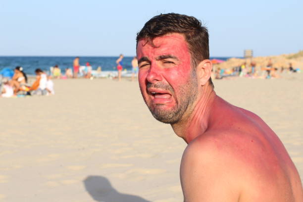 homme pleurer après avoir sauvagement brûlée par le soleil - travel red vacations outdoors photos et images de collection