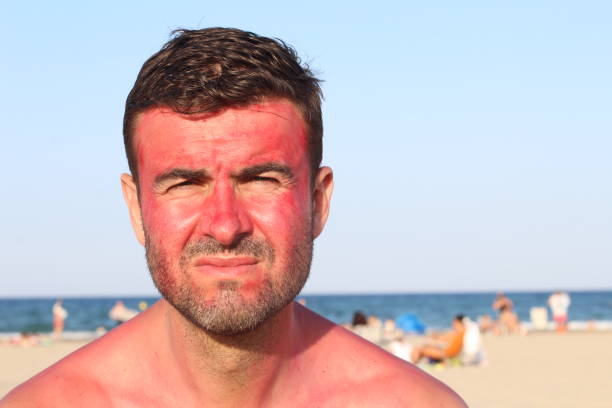 Man with lost of redness after suntanning.