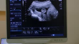 Embarazo Ecografía De Ultrasonido Exploración Pantalla De Feto De Bebé De 2  º Trimestre Vídeo Stock y más Footage de Bebé - iStock