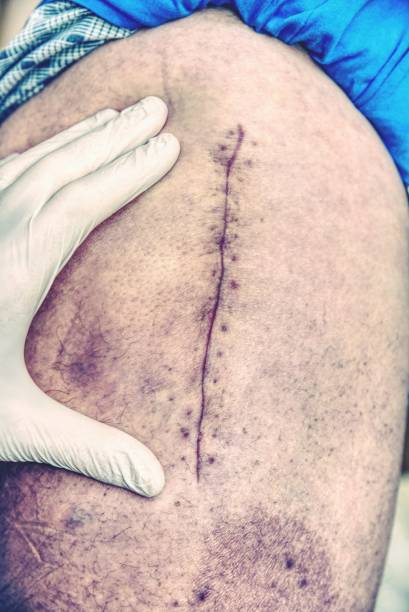 흉터와 오래 된 인간의 다리의 선택적 초점입니다.  긴 흉터 환자 - pacemaker torso chest male 뉴스 사진 이미지