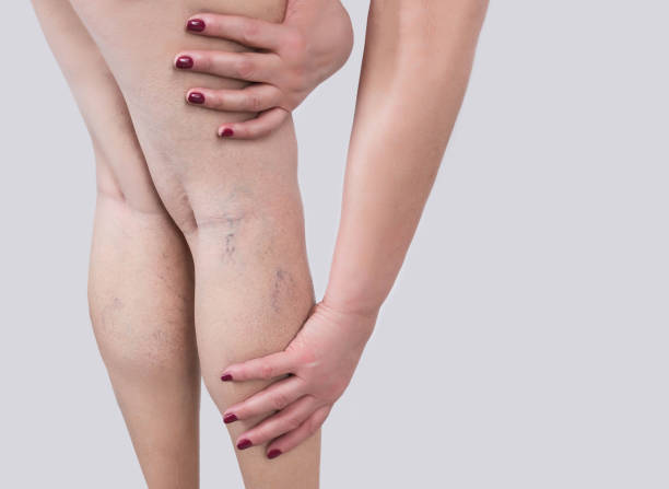 de spataderen op een benen van vrouw - woman legs veins stockfoto's en -beelden